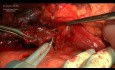 Left Hepatectomy for HCC. Moderataly Severe Cirrhosis (Class B)