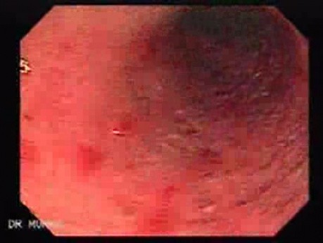 Colitis Ulcerosa - Pseudopolyps (16 of 22)
