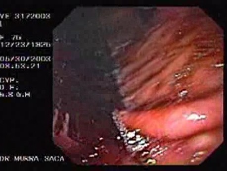 Upper Gastrointestinal Bleeding (6 of 15)
