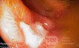 Cecal Ulcer induced by NSAID's