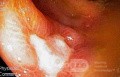 Cecal Ulcer induced by NSAID's