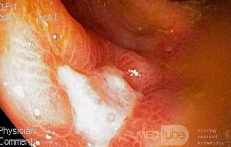 Cecal Ulcer induced by NSAID's