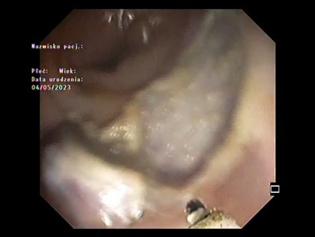 ESD + Resection Bed Clipping