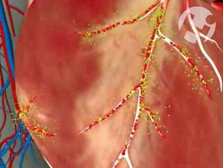 Decreased Blood Flow
