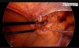 Laparoscopic Inguinal Hernia Repair in Female