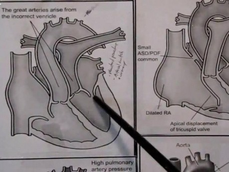Congenital Heart Defects and Fetal CV - Lecture - 3/4