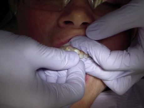 Traxodent - Push Away Gingival Tissue And Stop Hemorrhage