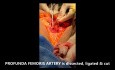 Above Knee Amputation