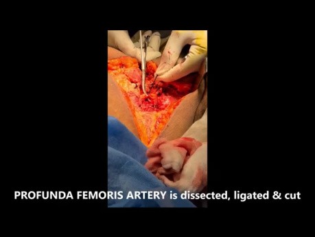 Above Knee Amputation