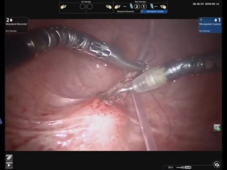 Robotic Vesicoscopic Cohen's Reimplantation In Pediatric Vesico-Ureteric Reflux