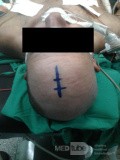 Acute Spontaneous Subdural Hemorrhage in the Subdural Space