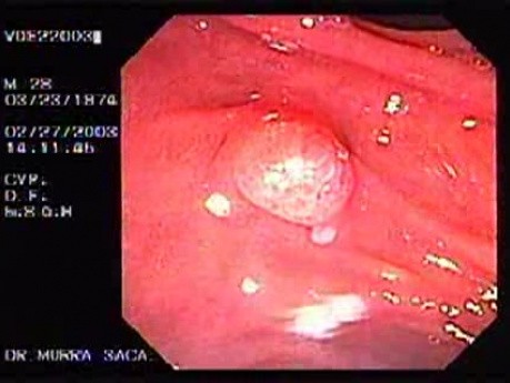 Familial Adenomatous Polyposis of the Colon (22 of 29)