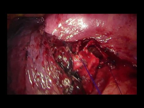 Uniportal VATS Left Lower Sleeve Anastomosis