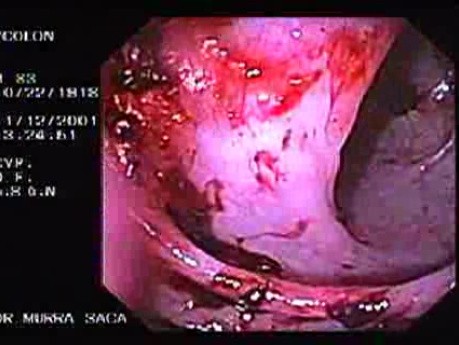 Diverticular Disease - Hemorrhage (3 of 15)