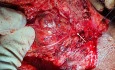 Deep Lobe Parotid Tumour (Exposure after Superficial Parotidectomy)