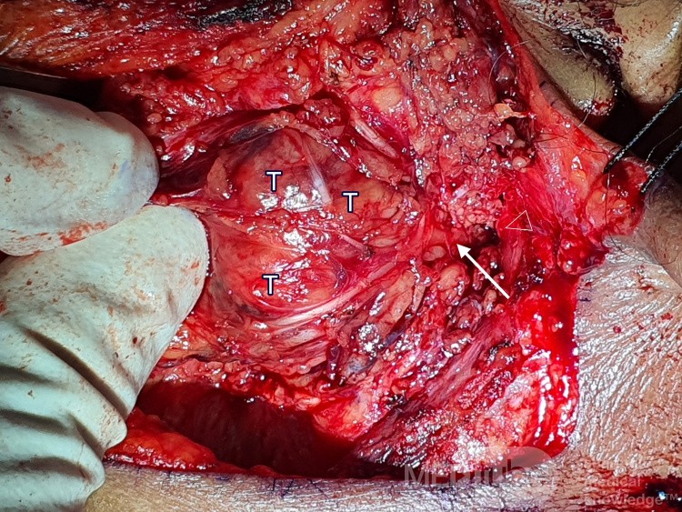 Deep Lobe Parotid Tumour (Exposure after Superficial Parotidectomy)
