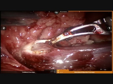 Robotic Bilateral Approach - Thymoma Resection