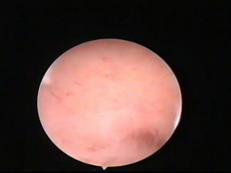 Cervix Obstructed By Intrauterine Adhesions - Hysteroscopic Treatment