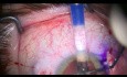 Intrascleral Fixation of Carlevale Combined with Decrease of the Pupil Size