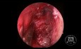 Inverted Papilloma Resection (HD Video)