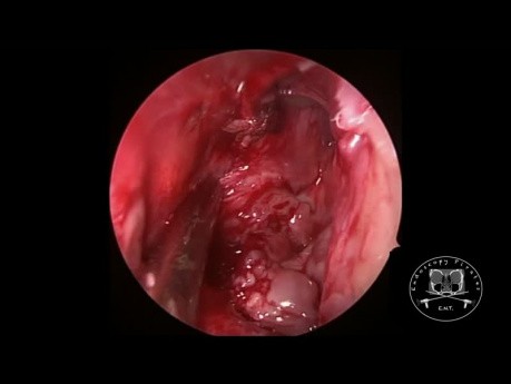Inverted Papilloma Resection (HD Video)