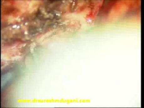 Olfactory groove meningioma-microsurgical excision