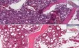 Adenocarcinoma, metastatic - Histopathology - Bone marrow