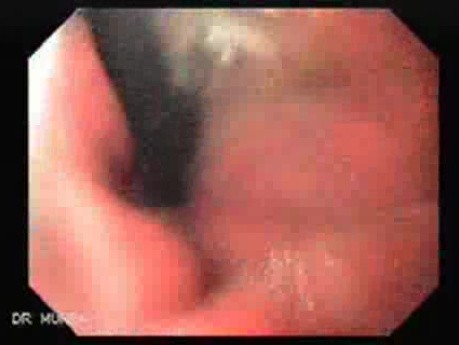 Barrett Adenocarcinoma - Therapeutic Endoscopy (3 of 7)