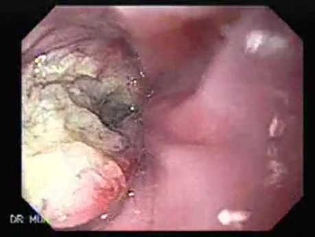 Esophageal Squamous Cell Carcinoma (2 of 5)