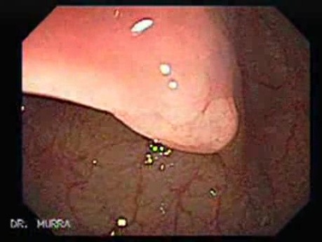 Flat Adenoma (1 of 3)
