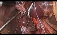 Laparoscopic Cholecystectomy by Knotting Cystic Duct