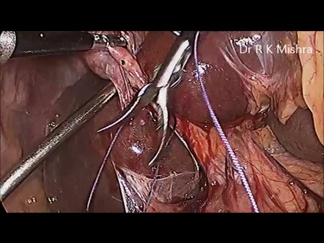Laparoscopic Cholecystectomy by Knotting Cystic Duct