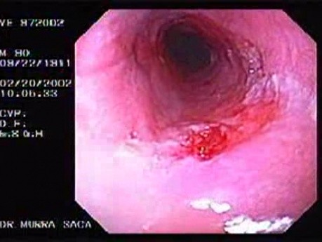 Barrett´s Esophagus -adenocarcinoma-  (2 of 4)