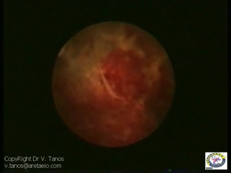 Embryo Missing Right Eye