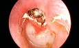 Left Ear Cholesteatoma with Attic Perforation