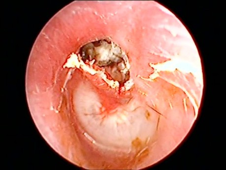 Left Ear Cholesteatoma with Attic Perforation