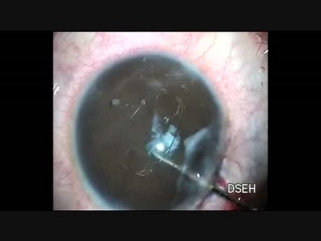 Iris Claw Implantation in Traumatic Aphakia