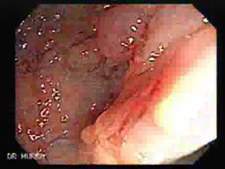 Familial Adenomatous Polyposis (2 of 36)