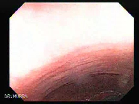 Colonoscopic Polypectomy (1 of 29)