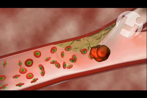 The Effect of Aspirin on Clot Formation • Video • 