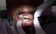 Check Mandibular Partial Denture Stability
