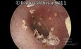Epithelial Debris in Ear Canal From Desquamation