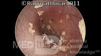 Epithelial Debris in Ear Canal From Desquamation