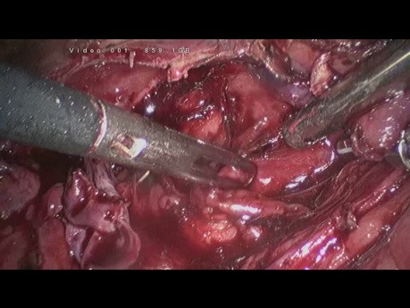 Laparoscopic Cyst Excision