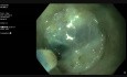 Endoscopic Submucosal Dissection in Mid-Rectum