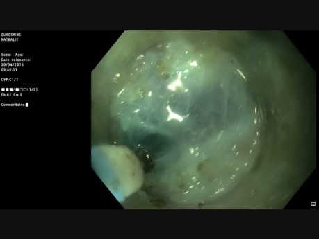 Endoscopic Submucosal Dissection in Mid-Rectum