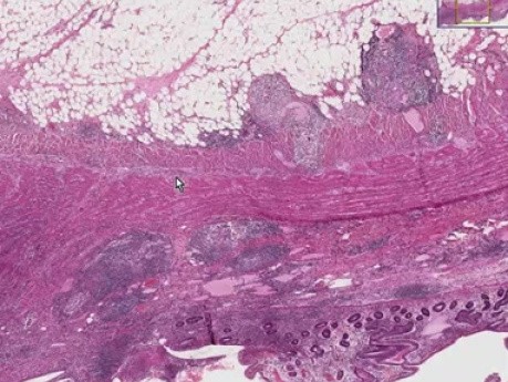 Small intestine - Crohn disease