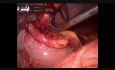 Laparoscopy For Peritonitis