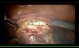 Robotic Hysterectomy Lymph Node Dissection