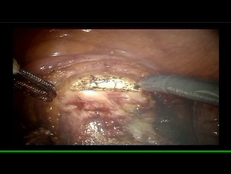 Robotic Hysterectomy Lymph Node Dissection